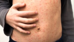 В Петропавловске курсанты академии Нацгвардии заразились корью